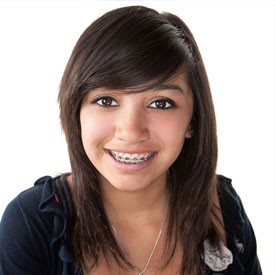 self ligating braces